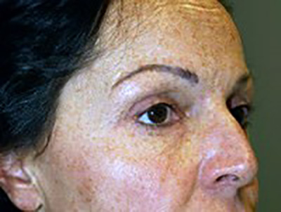 eyelid-lift-blepharoplasty-plastic-surgery-redlands-woman-before-oblique-dr-maan-kattash