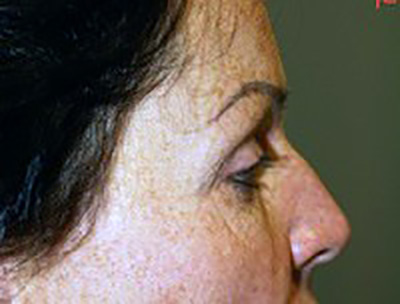 eyelid-lift-blepharoplasty-plastic-surgery-redlands-woman-before-side-dr-maan-kattash