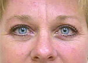 eyelid-lift-blepharoplasty-plastic-surgery-tustin-woman-after-front-dr-maan-kattash
