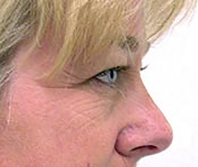 eyelid-lift-blepharoplasty-plastic-surgery-tustin-woman-before-side-dr-maan-kattash