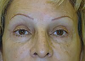 eyelid-lift-blepharoplasty-plastic-surgery-upland-woman-after-front-dr-maan-kattash