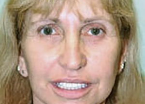 facelift-plastic-surgery-irvine-woman-after-front-dr-maan-kattash