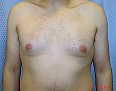 gynecomastia-male-breast-reduction-surgery-claremont-before-front-dr-maan-kattash