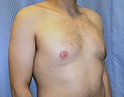 gynecomastia-male-breast-reduction-surgery-claremont-before-oblique-dr-maan-kattash
