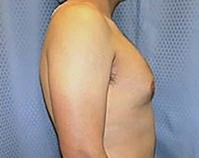 gynecomastia-male-breast-reduction-surgery-claremont-before-side-dr-maan-kattash