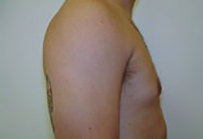 gynecomastia-male-breast-reduction-surgery-ontario-after-side-dr-maan-kattash