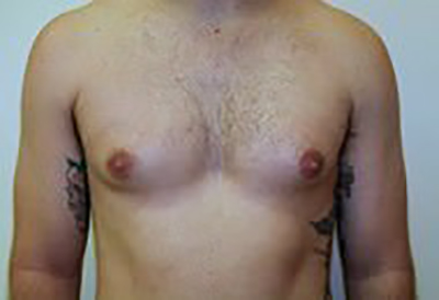 gynecomastia-male-breast-reduction-surgery-ontario-before-front-dr-maan-kattash