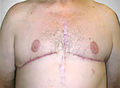 gynecomastia-male-breast-reduction-surgery-upland-after-front-dr-maan-kattash