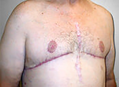 gynecomastia-male-breast-reduction-surgery-upland-after-oblique-dr-maan-kattash