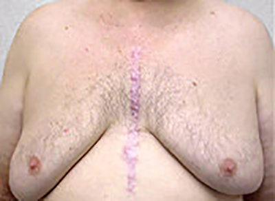 gynecomastia-male-breast-reduction-surgery-upland-before-front-dr-maan-kattash