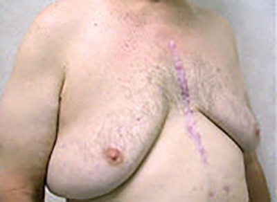 gynecomastia-male-breast-reduction-surgery-upland-before-oblique-dr-maan-kattash