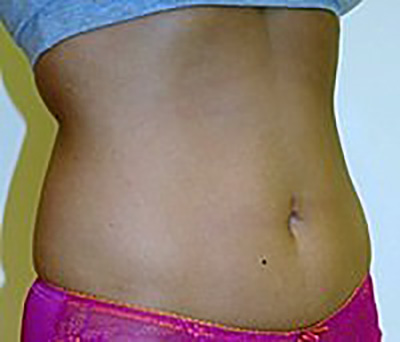 liposuction-plastic-surgery-los-angeles-woman-before-oblique-dr-maan-kattash