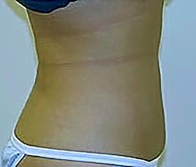 liposuction-plastic-surgery-los-angeles-woman-woman-after-side-dr-maan-kattash