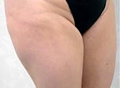 liposuction-plastic-surgery-rancho-cucamonga-woman-before-oblique-dr-maan-kattash