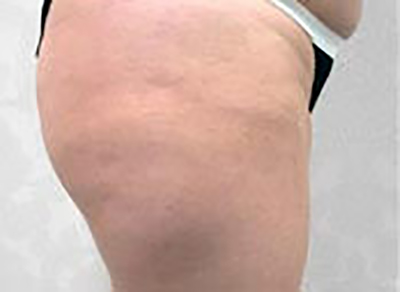 liposuction-plastic-surgery-rancho-cucamonga-woman-before-side-dr-maan-kattash