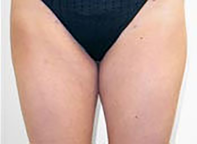 liposuction-plastic-surgery-rancho-cucamonga-woman-woman-after-front-dr-maan-kattash