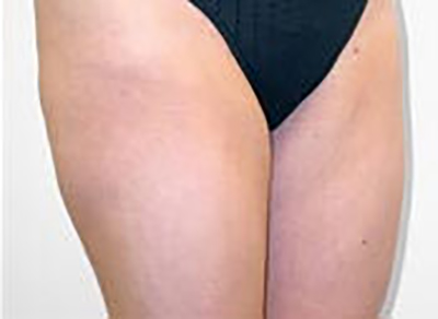 liposuction-plastic-surgery-rancho-cucamonga-woman-woman-after-oblique-dr-maan-kattash