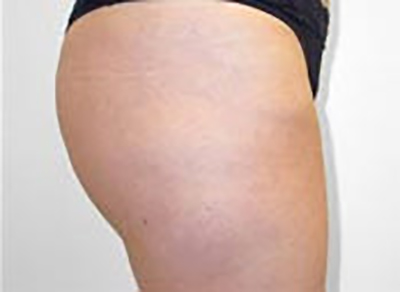 liposuction-plastic-surgery-rancho-cucamonga-woman-woman-after-side-dr-maan-kattash