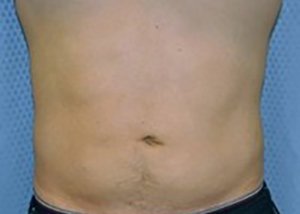 liposuction-plastic-surgery-upland-man-woman-after-front-dr-maan-kattash