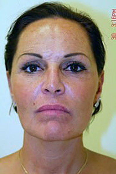 neck-lift-eyelid-lift-plastic-surgery-beverly-hills-woman-after-front-dr-maan-kattash