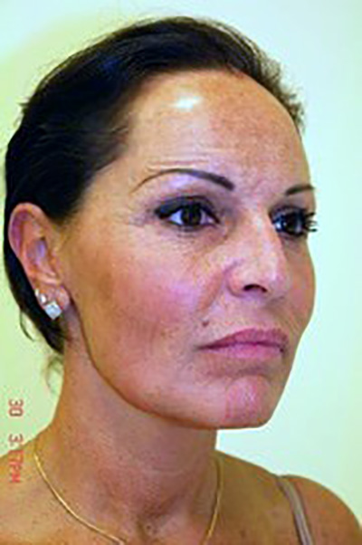 neck-lift-eyelid-lift-plastic-surgery-beverly-hills-woman-after-oblique-dr-maan-kattash