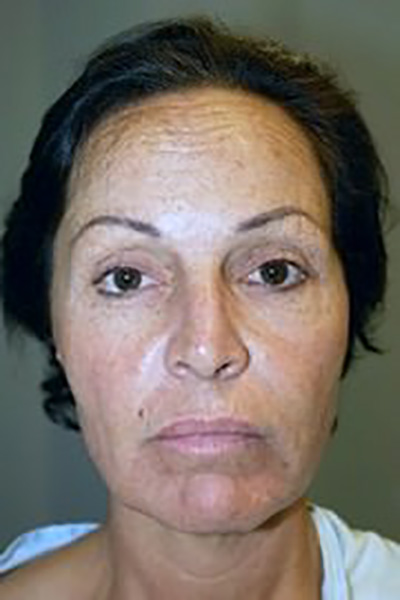 neck-lift-eyelid-lift-plastic-surgery-beverly-hills-woman-before-front-dr-maan-kattash