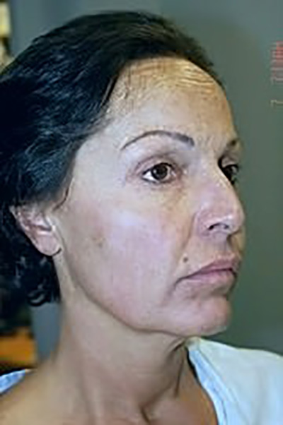 neck-lift-eyelid-lift-plastic-surgery-beverly-hills-woman-before-oblique-dr-maan-kattash
