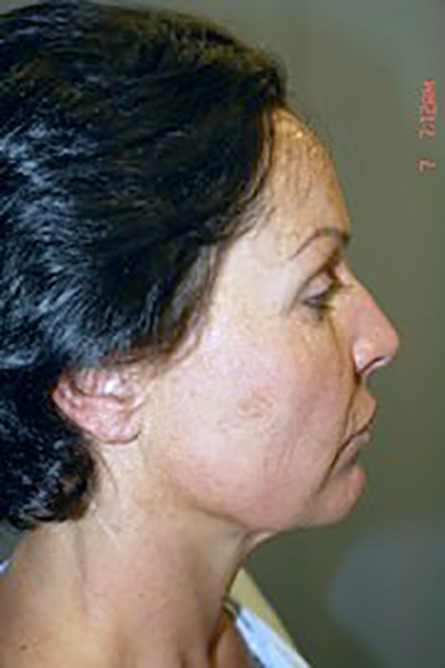 neck-lift-eyelid-lift-plastic-surgery-beverly-hills-woman-before-side-dr-maan-kattash