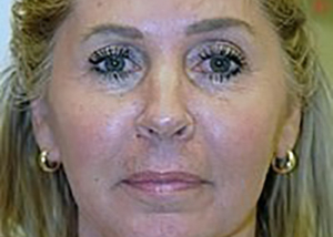 neck-lift-plastic-surgery-beverly-hills-woman-after-front-dr-maan-kattash