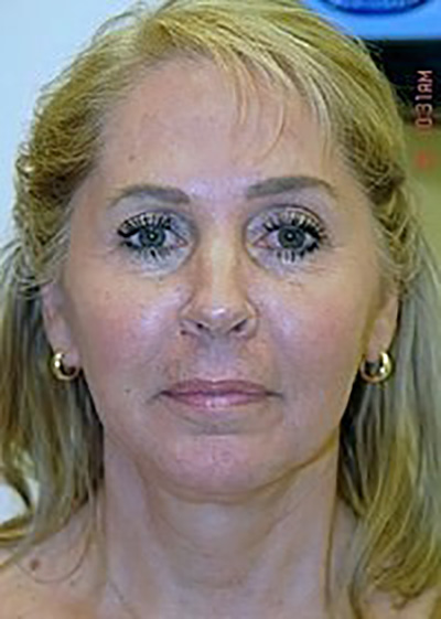 neck-lift-plastic-surgery-beverly-hills-woman-after-front-dr-maan-kattash