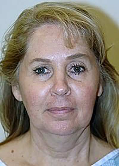 neck-lift-plastic-surgery-beverly-hills-woman-before-front-dr-maan-kattash