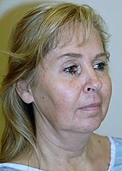 neck-lift-plastic-surgery-beverly-hills-woman-before-oblique-dr-maan-kattash