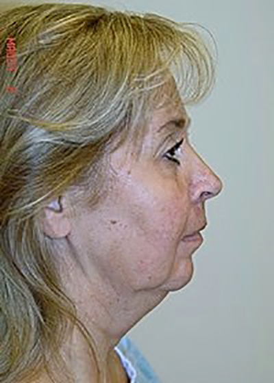 neck-lift-plastic-surgery-beverly-hills-woman-before-side-dr-maan-kattash