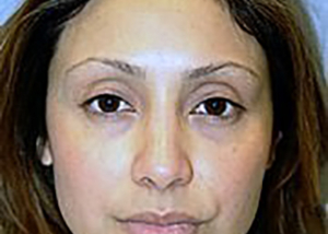 rhinoplasty-plastic-surgery-nose-job-claremont-woman-after-front-dr-maan-kattash2