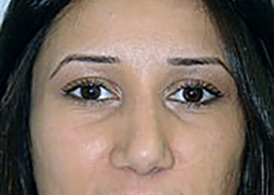 rhinoplasty-plastic-surgery-nose-job-inland-empire-woman-after-front-dr-maan-kattash2