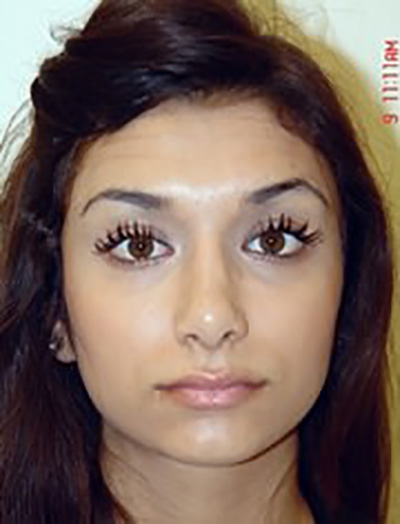 rhinoplasty-plastic-surgery-nose-job-irvine-woman-after-front-dr-maan-kattash2