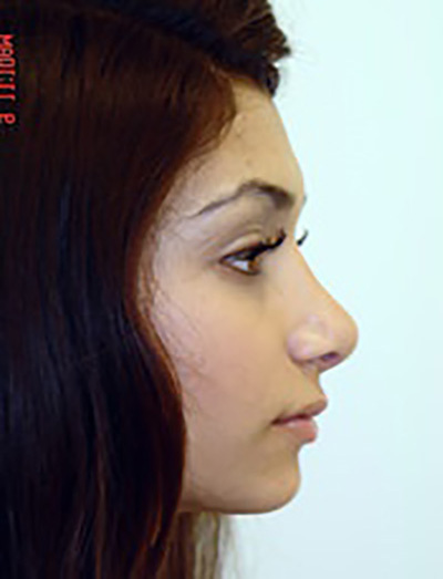 rhinoplasty-plastic-surgery-nose-job-irvine-woman-after-side-dr-maan-kattash2b