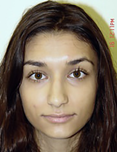 rhinoplasty-plastic-surgery-nose-job-irvine-woman-before-front-dr-maan-kattash2