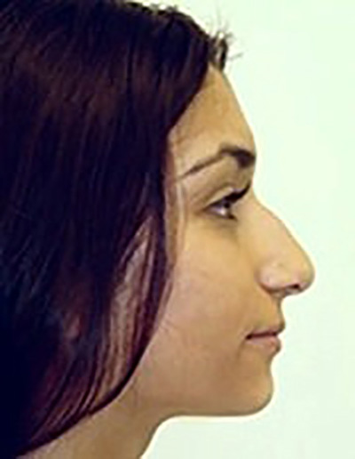 rhinoplasty-plastic-surgery-nose-job-irvine-woman-before-side-dr-maan-kattash4