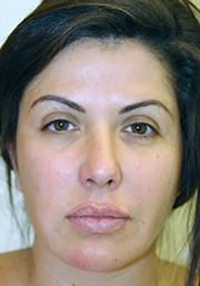 rhinoplasty-plastic-surgery-nose-job-los-angeles-woman-before-front-dr-maan-kattash2