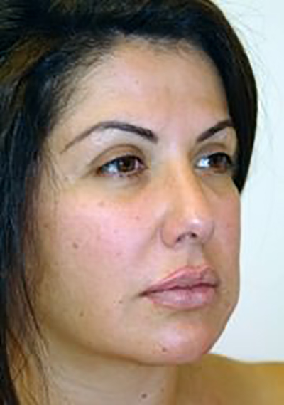 rhinoplasty-plastic-surgery-nose-job-los-angeles-woman-before-obique-dr-maan-kattash2