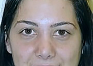 rhinoplasty-plastic-surgery-nose-job-ontario-woman-after-front-dr-maan-kattash2