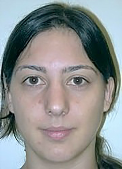 rhinoplasty-plastic-surgery-nose-job-ontario-woman-before-front-dr-maan-kattash2