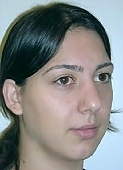 rhinoplasty-plastic-surgery-nose-job-ontario-woman-before-oblique-dr-maan-kattash2
