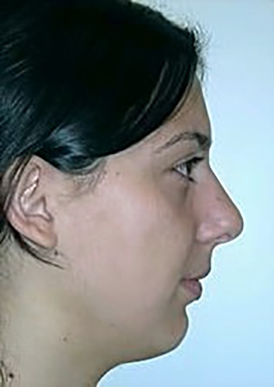 rhinoplasty-plastic-surgery-nose-job-ontario-woman-before-side-dr-maan-kattash2