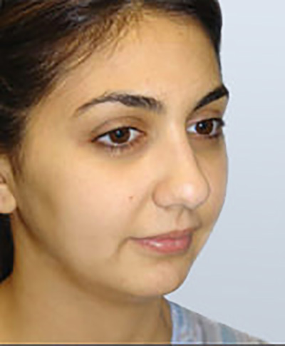 rhinoplasty-plastic-surgery-nose-job-orange-county-woman-before-oblique-dr-maan-kattash2