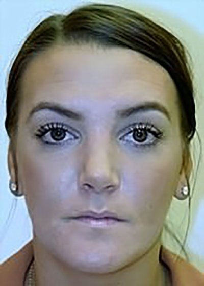 rhinoplasty-plastic-surgery-nose-job-rancho-cucamonga-woman-after-front-dr-maan-kattash