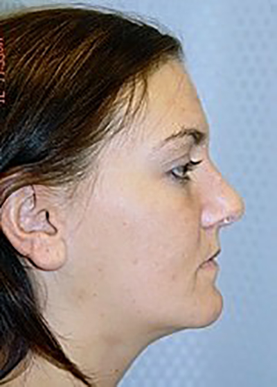 rhinoplasty-plastic-surgery-nose-job-rancho-cucamonga-woman-before-side-dr-maan-kattash2
