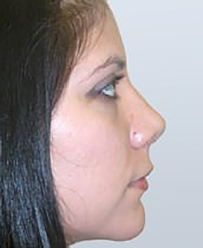 rhinoplasty-plastic-surgery-nose-job-tustin-woman-after-side-dr-maan-kattash2
