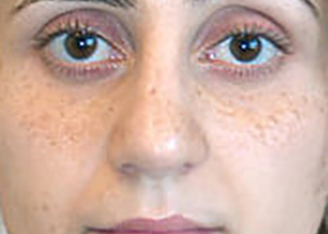 rhinoplasty-surgery-nose-job-tustin-woman-after-front-dr-maan-kattash2